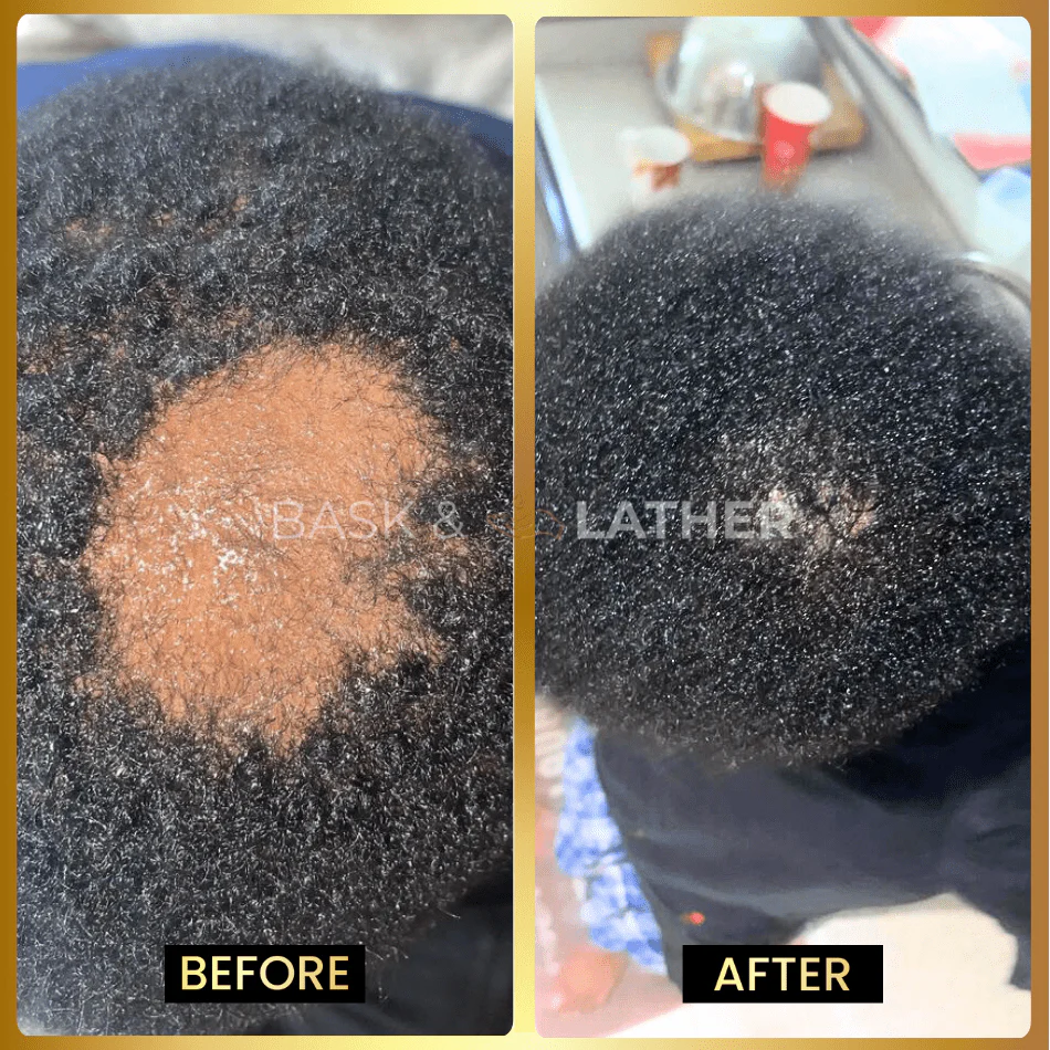 Scalp Stimulator - 3 Month Supply - Image 3